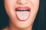 Boutons sur la langue: causes, symptômes, traitements naturels